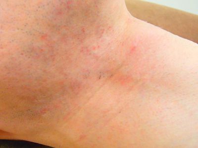 ヒゲ脱毛により肌荒れ改善