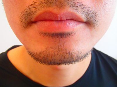デザインヒゲ脱毛2年後